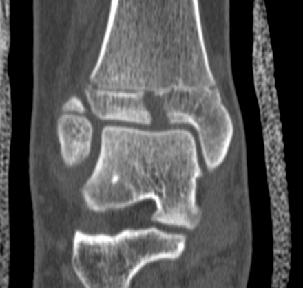 Tillaux Fracture CT Coronal 